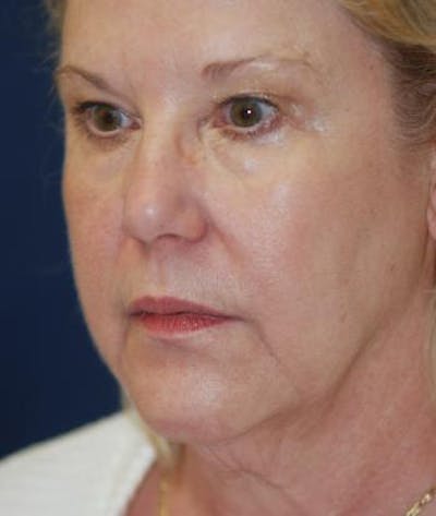 Facelift Before & After Gallery - Patient 198541 - Image 1