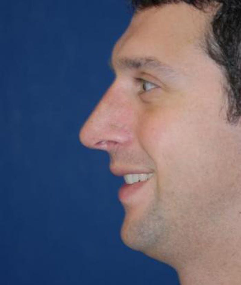 Rhinoplasty Before & After Gallery - Patient 375556 - Image 4