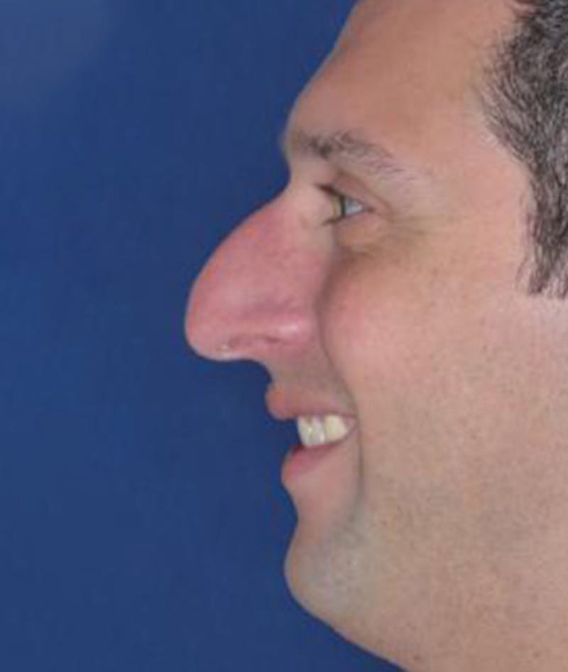 Rhinoplasty Before & After Gallery - Patient 375556 - Image 3