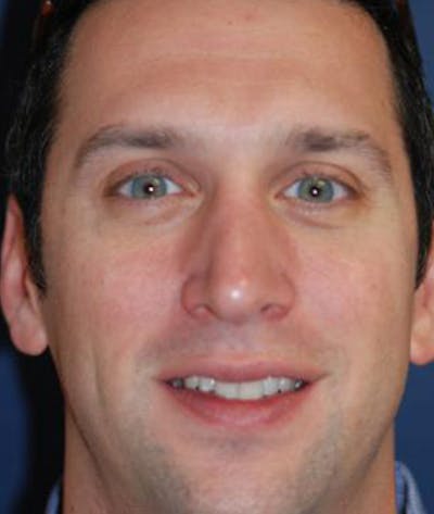 Rhinoplasty Before & After Gallery - Patient 375556 - Image 2