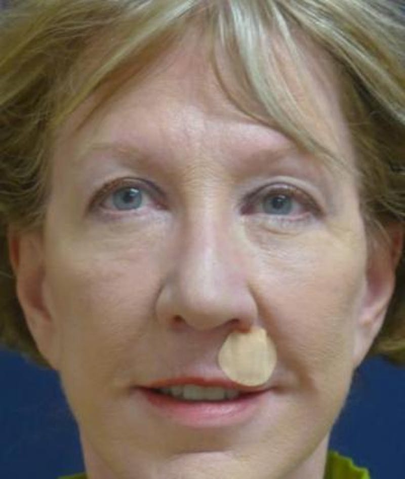 Facelift Before & After Gallery - Patient 196550 - Image 4
