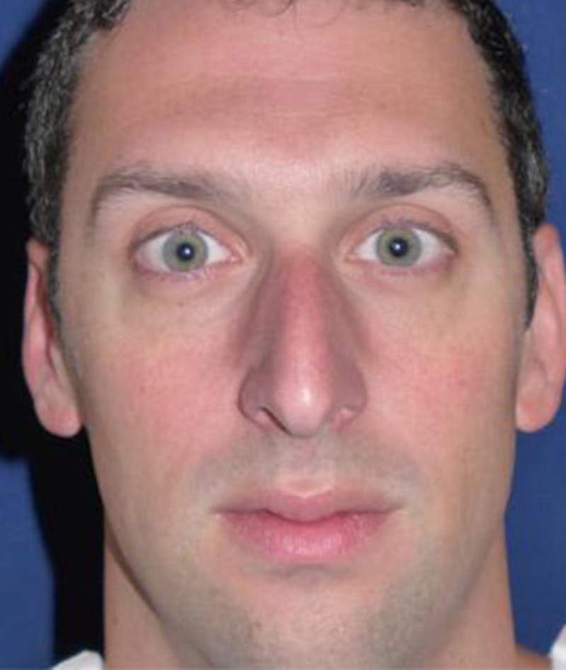Rhinoplasty Before & After Gallery - Patient 375556 - Image 1