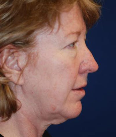 Facelift Before & After Gallery - Patient 196550 - Image 1