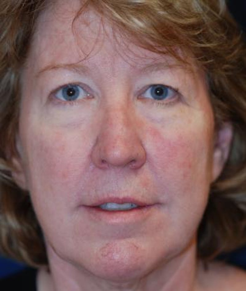 Facelift Before & After Gallery - Patient 196550 - Image 3