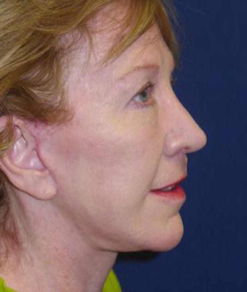 Facelift Before & After Gallery - Patient 196550 - Image 2