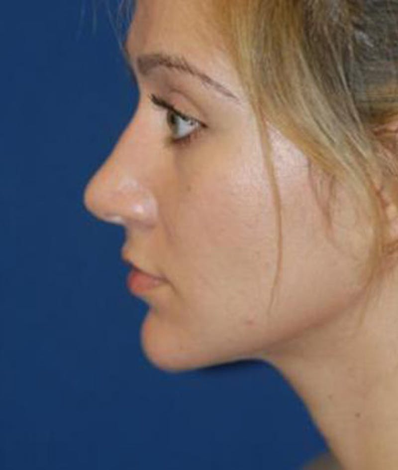 Rhinoplasty Before & After Gallery - Patient 154968 - Image 6