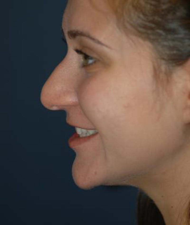 Rhinoplasty Before & After Gallery - Patient 154968 - Image 5