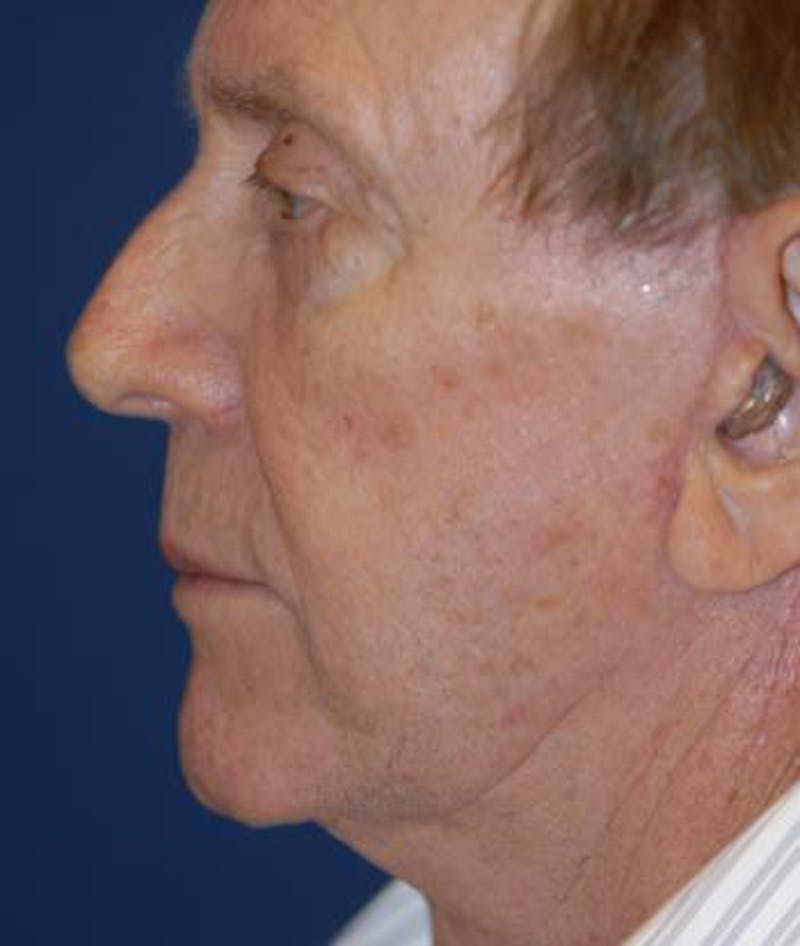 Facelift Before & After Gallery - Patient 243879 - Image 4