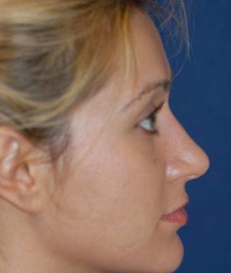 Rhinoplasty Before & After Gallery - Patient 154968 - Image 4