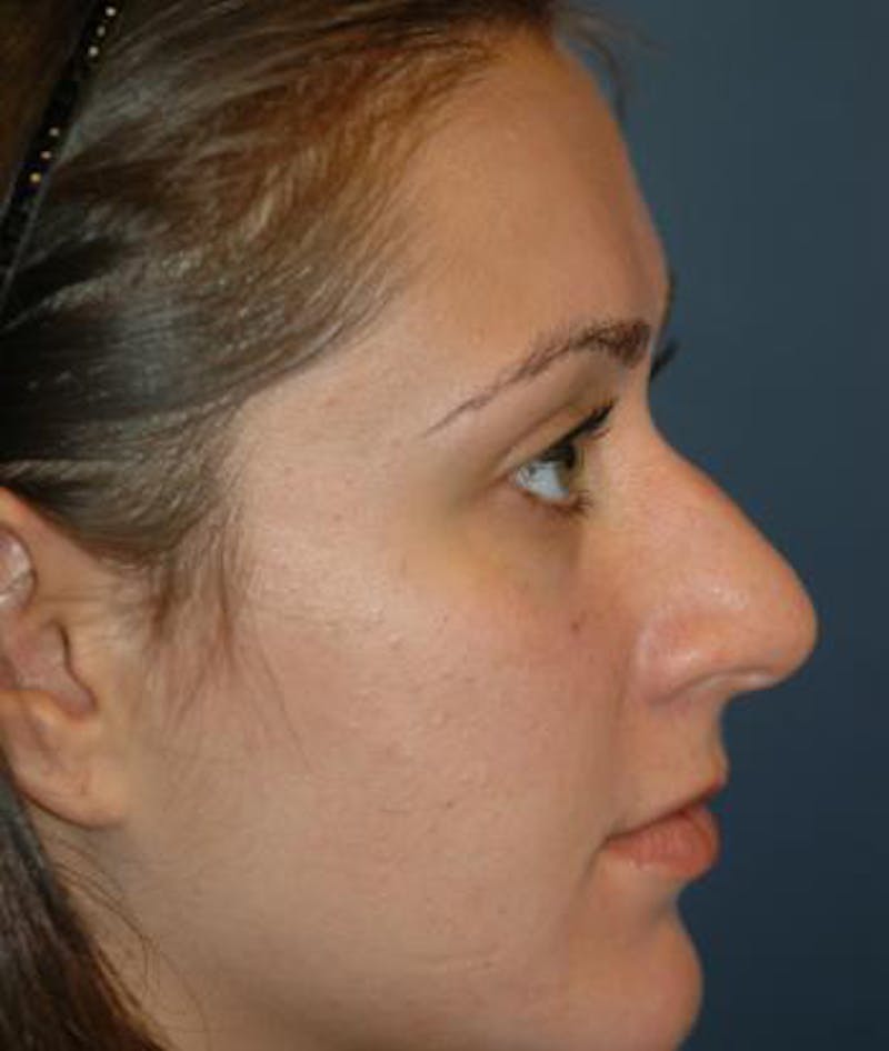 Rhinoplasty Before & After Gallery - Patient 154968 - Image 3