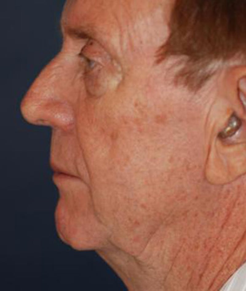 Facelift Before & After Gallery - Patient 243879 - Image 3