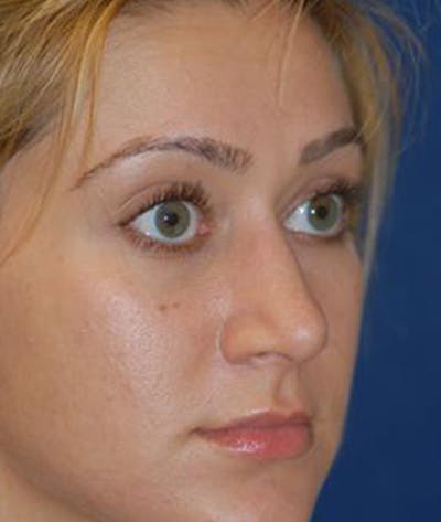 Rhinoplasty Before & After Gallery - Patient 154968 - Image 2
