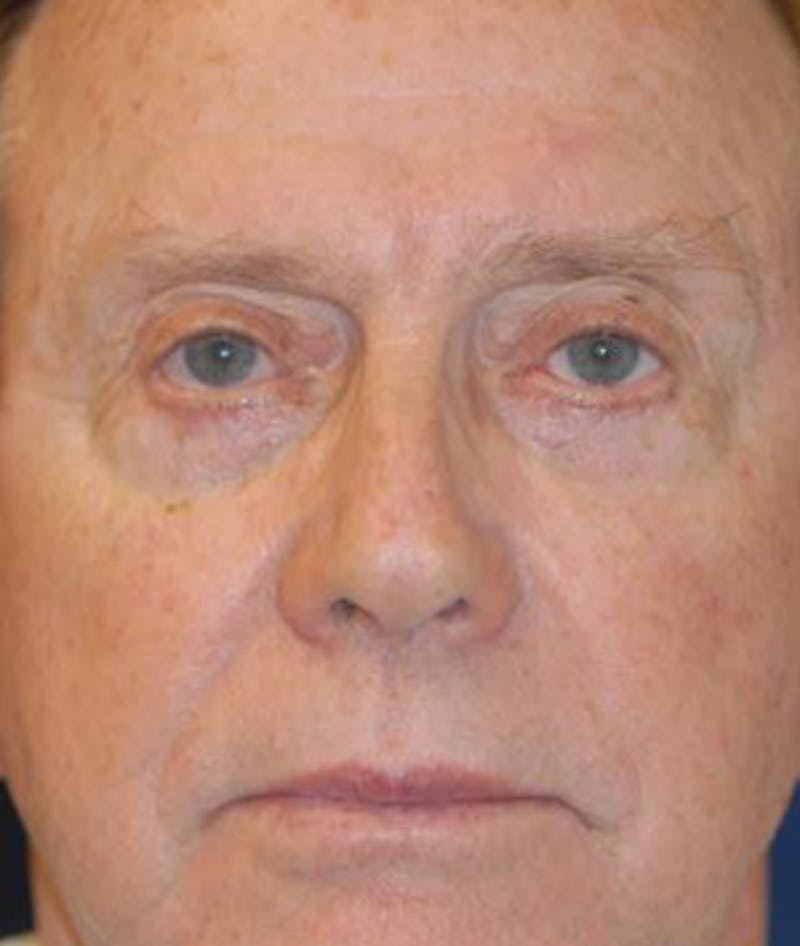 Facelift Before & After Gallery - Patient 243879 - Image 2