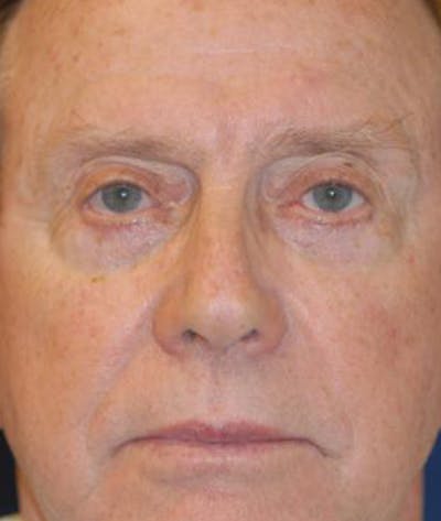 Facelift Before & After Gallery - Patient 243879 - Image 2
