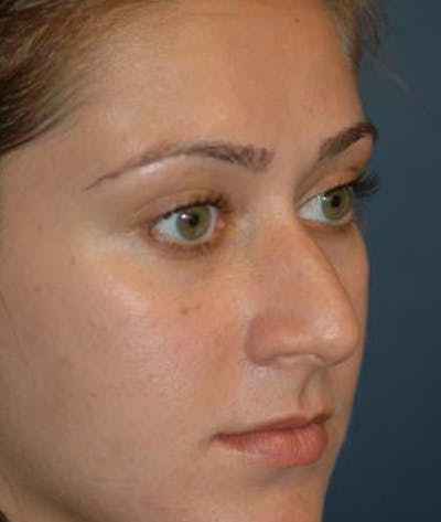 Rhinoplasty Before & After Gallery - Patient 154968 - Image 1