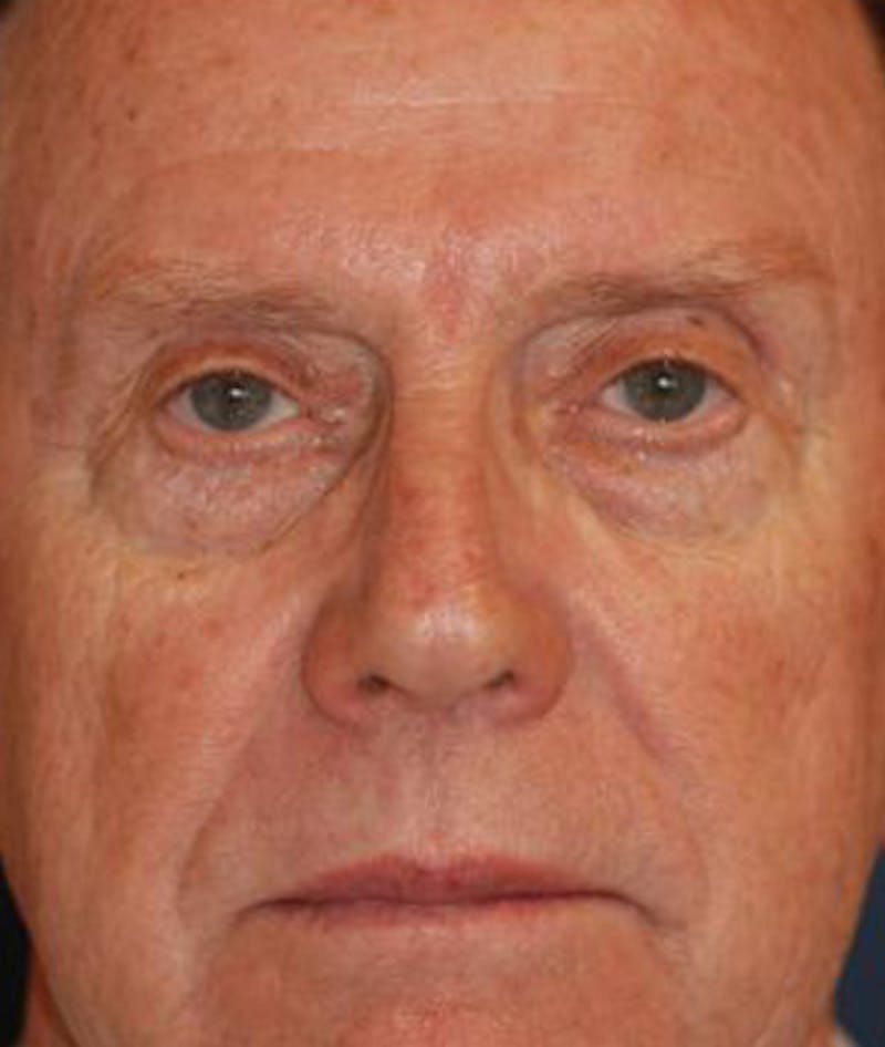 Facelift Before & After Gallery - Patient 243879 - Image 1