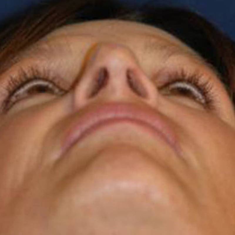 Rhinoplasty Before & After Gallery - Patient 302527 - Image 6