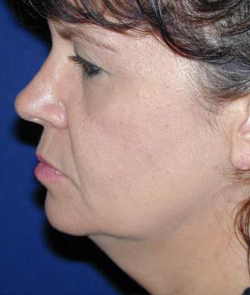 Facelift Before & After Gallery - Patient 373046 - Image 3