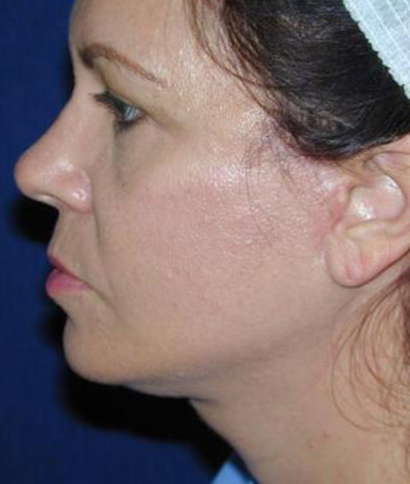 Facelift Before & After Gallery - Patient 373046 - Image 4