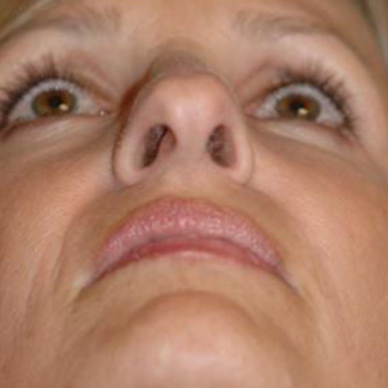 Rhinoplasty Before & After Gallery - Patient 302527 - Image 5