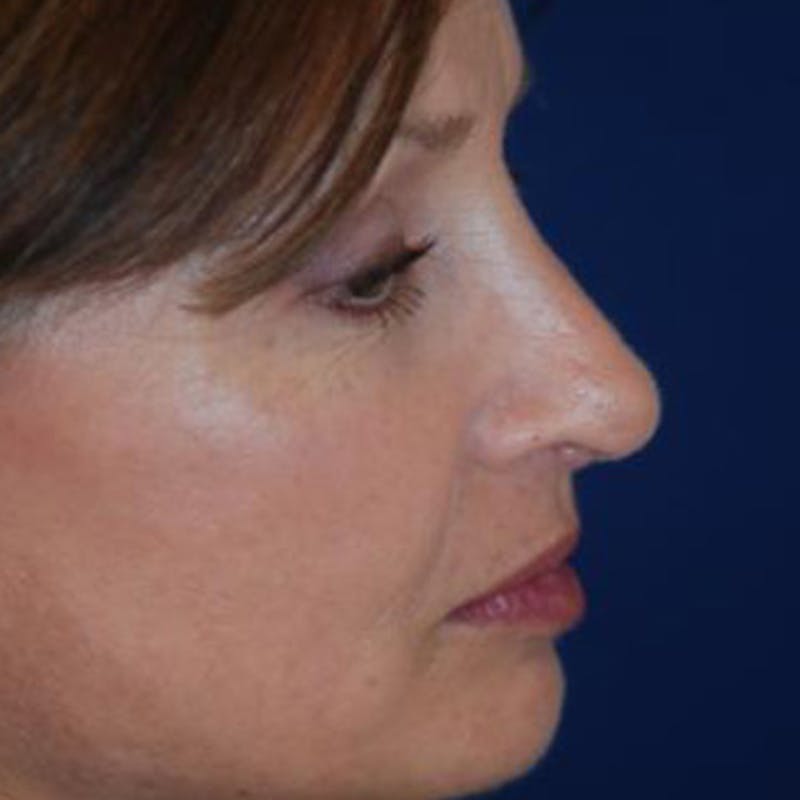 Rhinoplasty Before & After Gallery - Patient 302527 - Image 4