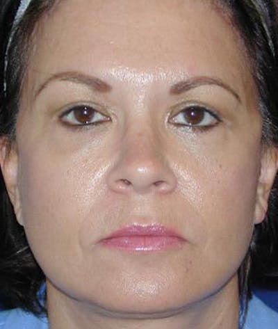 Facelift Before & After Gallery - Patient 373046 - Image 2