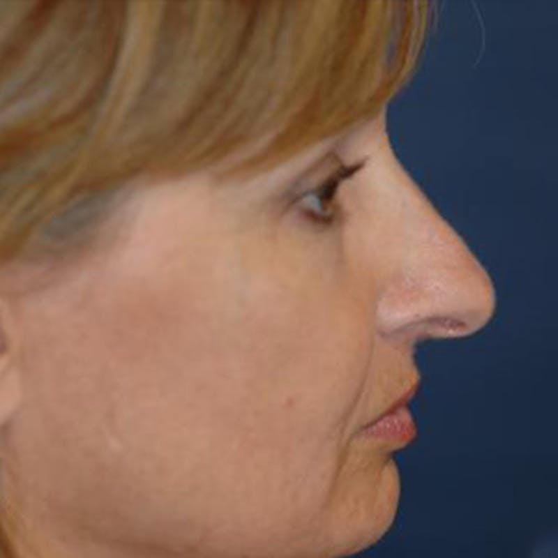 Rhinoplasty Before & After Gallery - Patient 302527 - Image 3