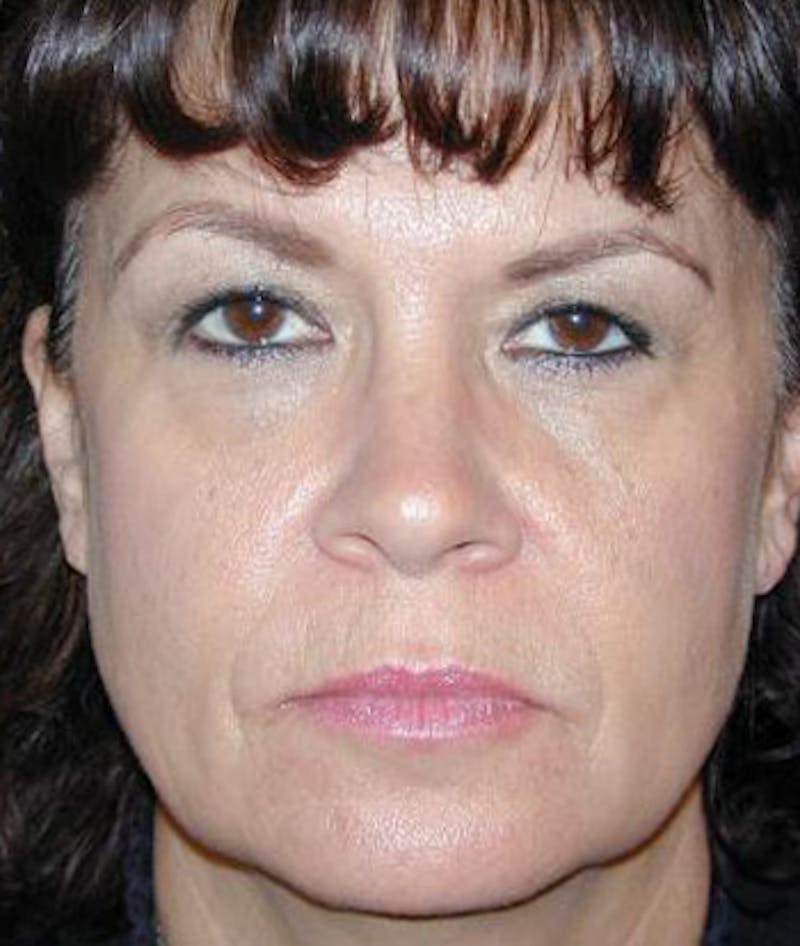 Facelift Before & After Gallery - Patient 373046 - Image 1