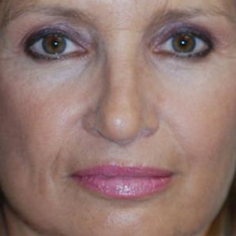 Rhinoplasty Before & After Gallery - Patient 302527 - Image 2