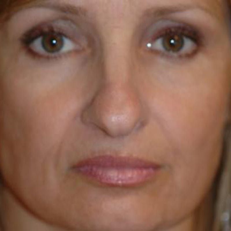 Rhinoplasty Before & After Gallery - Patient 302527 - Image 1