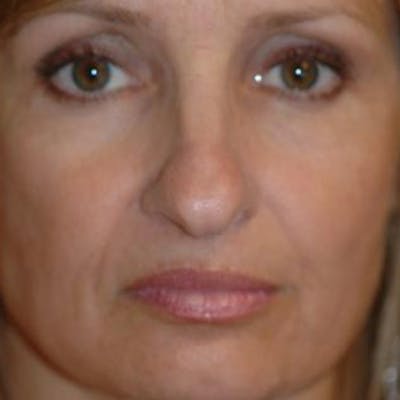 Rhinoplasty Before & After Gallery - Patient 302527 - Image 1