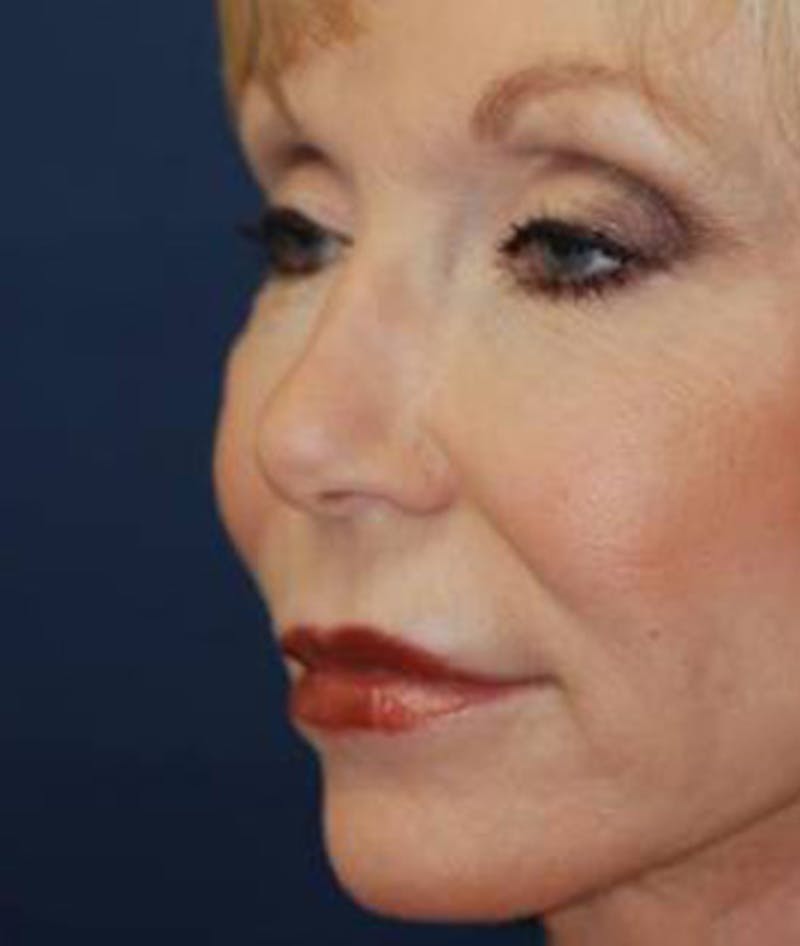 Facelift Before & After Gallery - Patient 211317 - Image 6