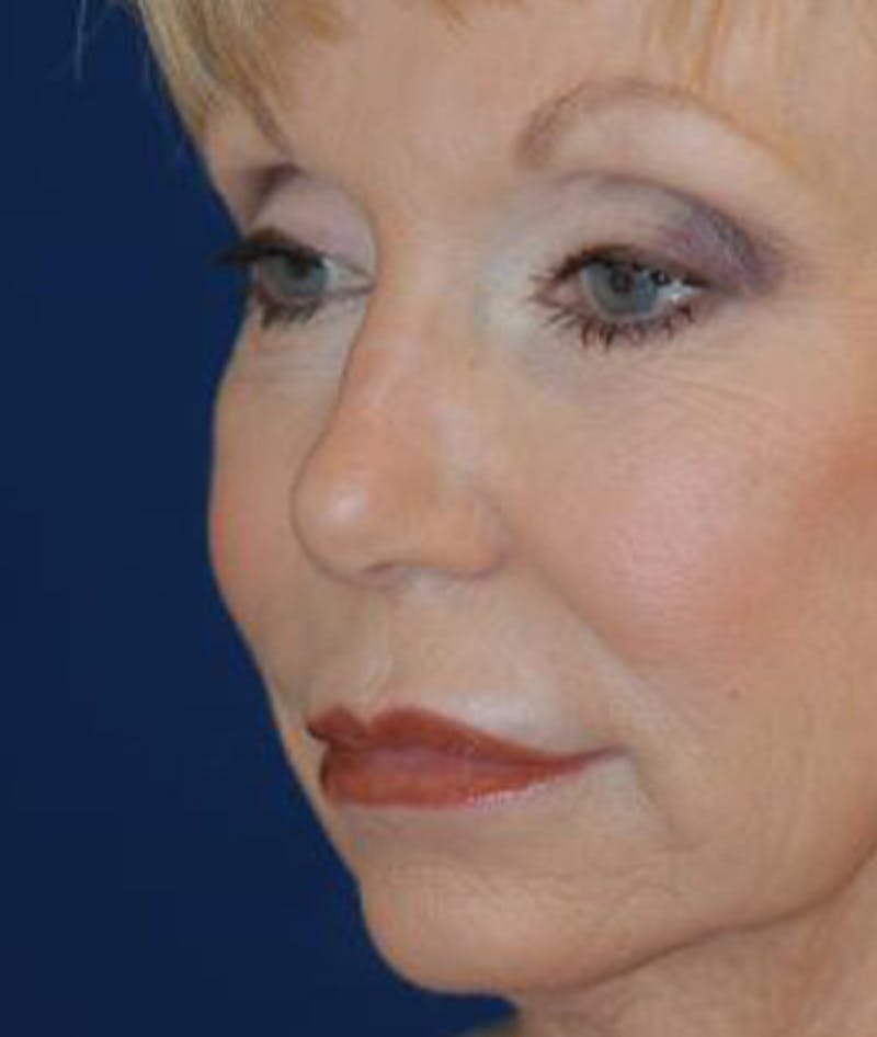 Facelift Before & After Gallery - Patient 211317 - Image 5