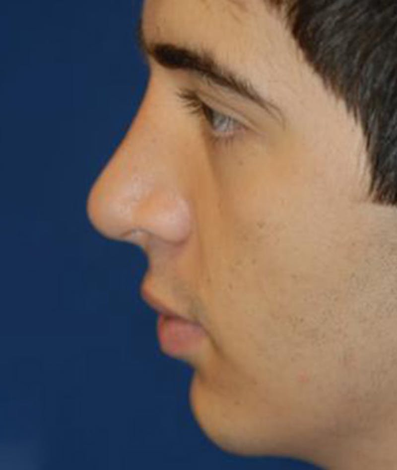 Rhinoplasty Before & After Gallery - Patient 376971 - Image 4