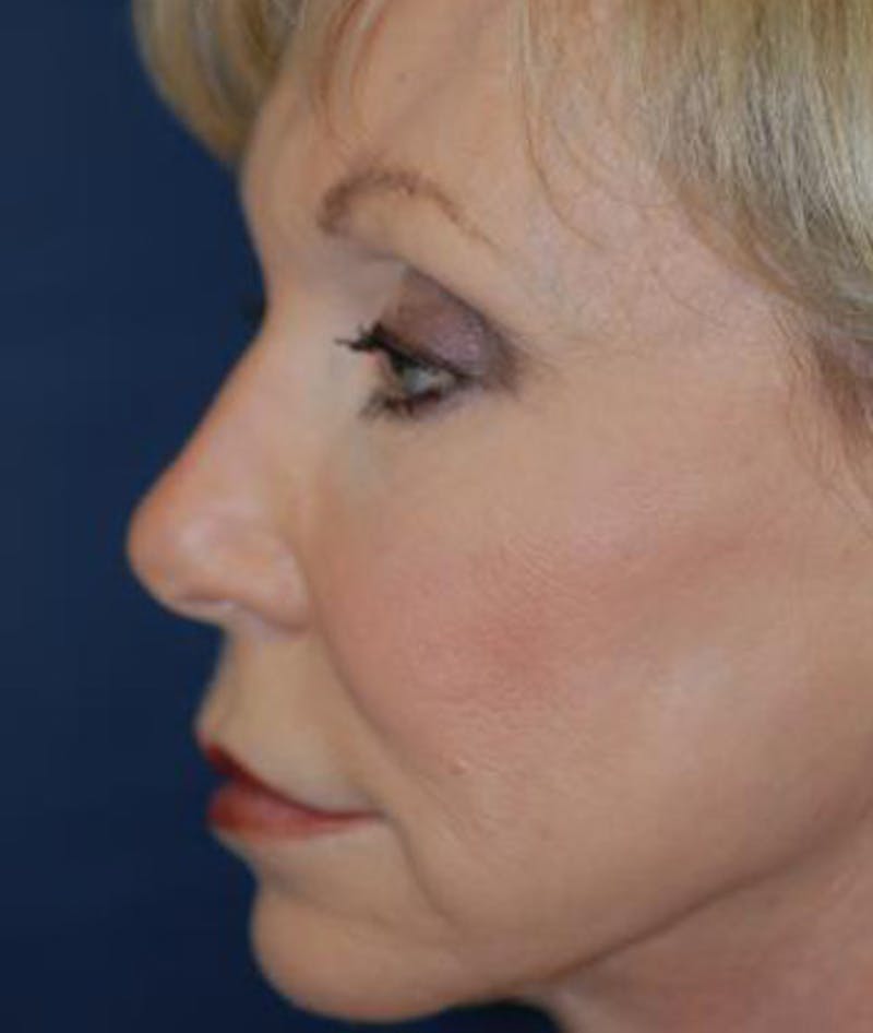 Facelift Before & After Gallery - Patient 211317 - Image 4