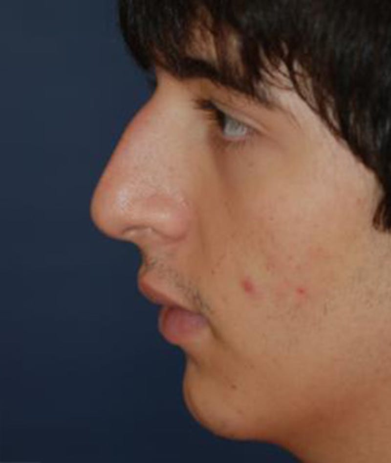 Rhinoplasty Before & After Gallery - Patient 376971 - Image 3