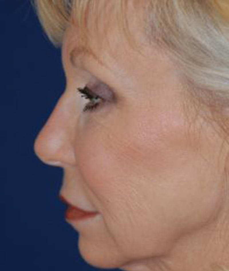 Facelift Before & After Gallery - Patient 211317 - Image 3