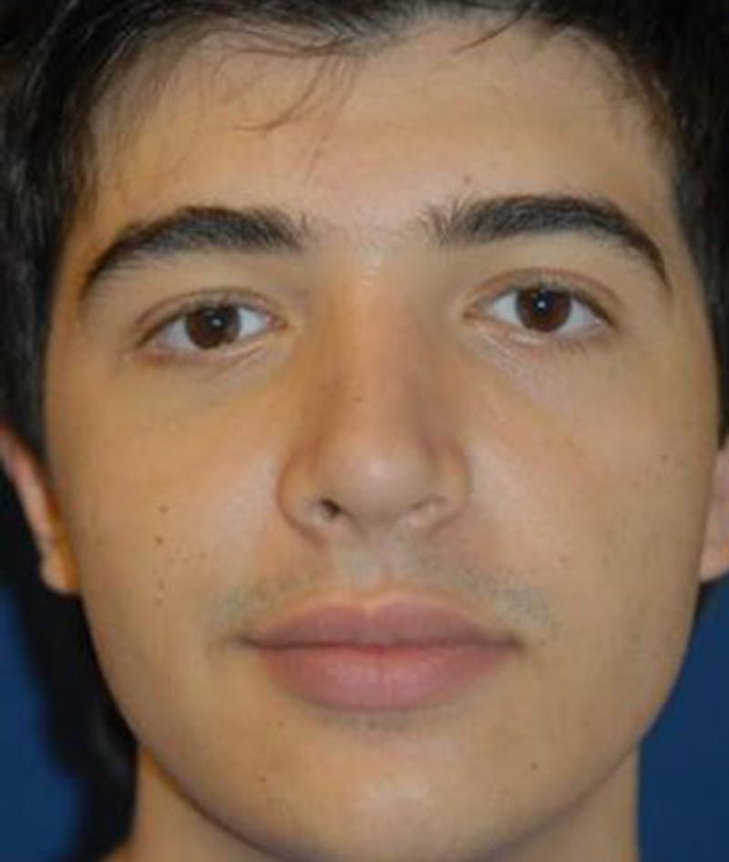 Rhinoplasty Before & After Gallery - Patient 376971 - Image 2