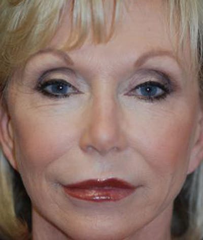 Facelift Before & After Gallery - Patient 211317 - Image 2
