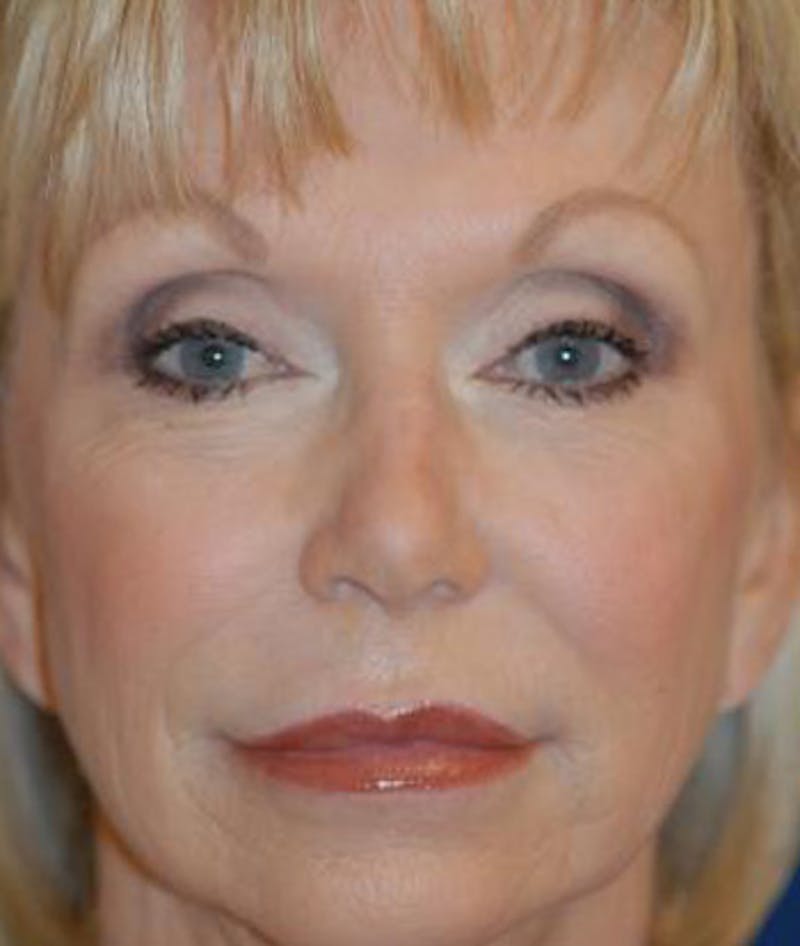 Facelift Before & After Gallery - Patient 211317 - Image 1