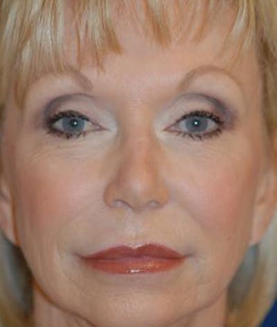 Facelift Before & After Gallery - Patient 211317 - Image 1