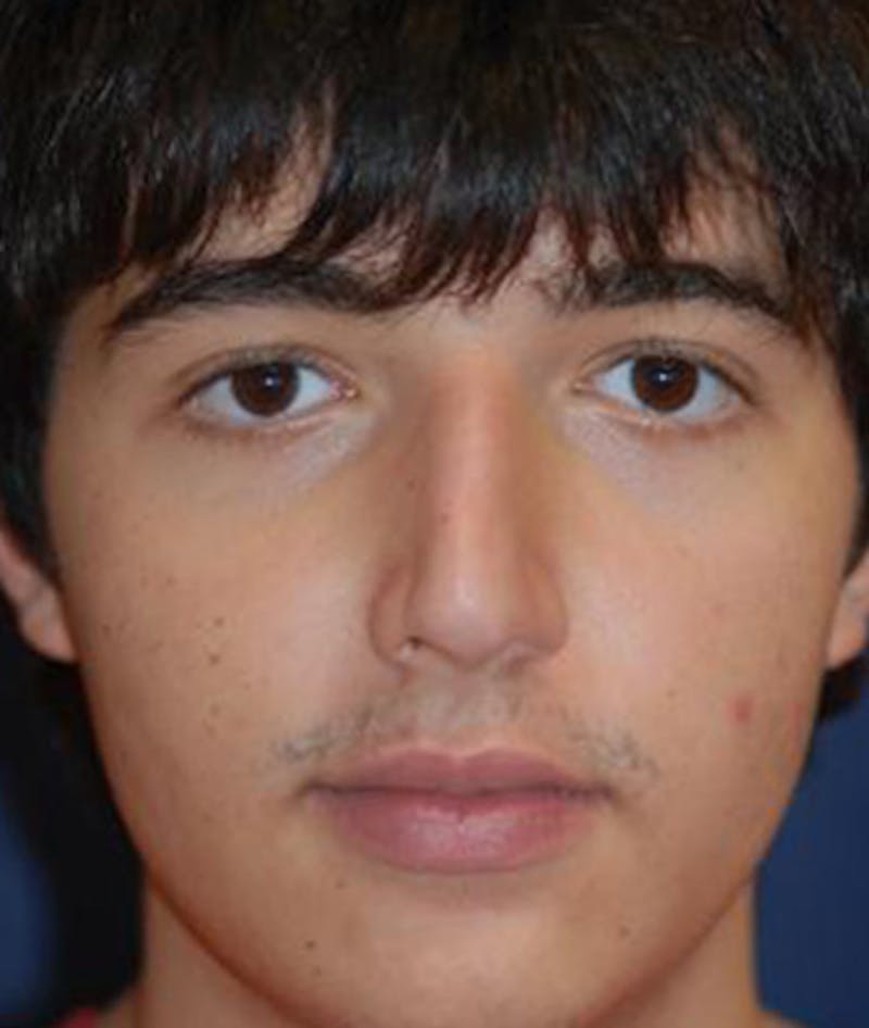 Rhinoplasty Before & After Gallery - Patient 376971 - Image 1