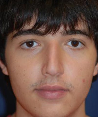 Rhinoplasty Before & After Gallery - Patient 376971 - Image 1