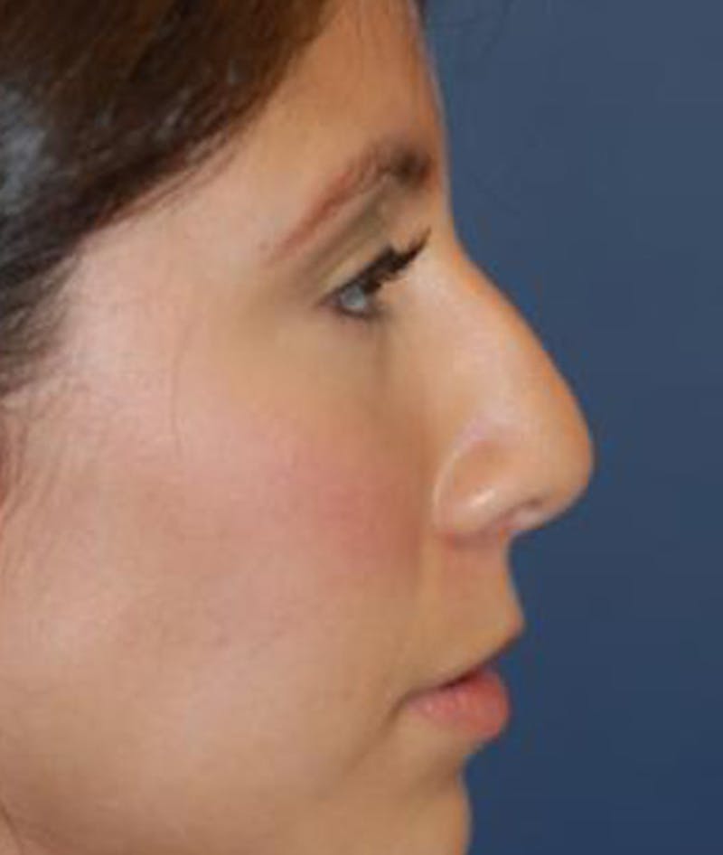 Rhinoplasty Before & After Gallery - Patient 357208 - Image 3