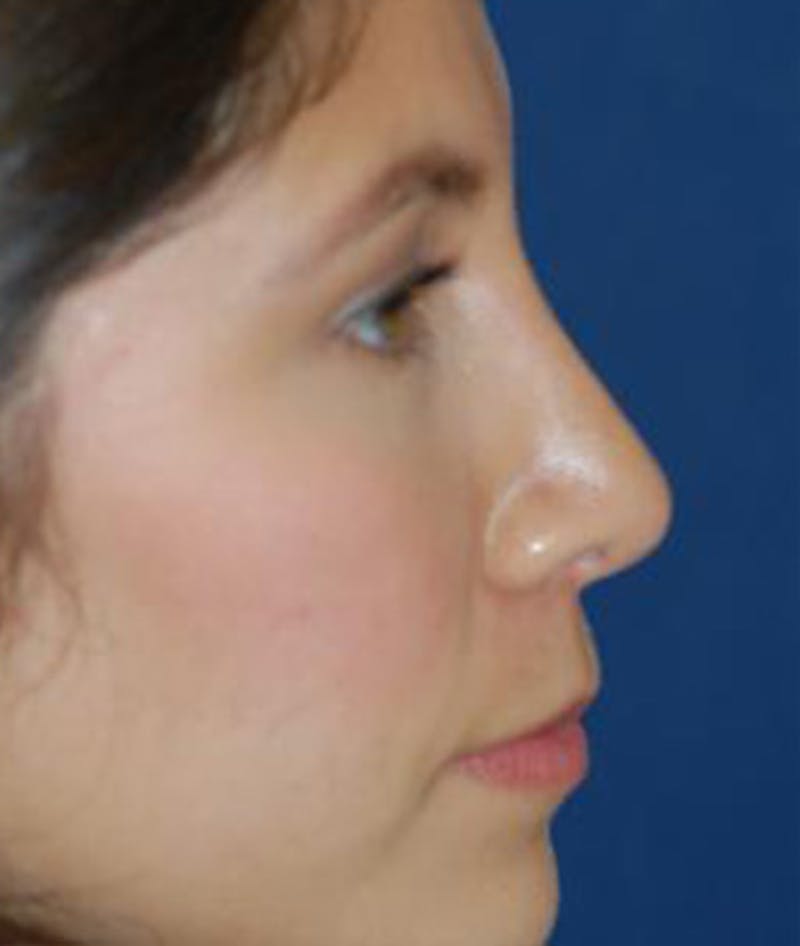 Rhinoplasty Before & After Gallery - Patient 357208 - Image 4