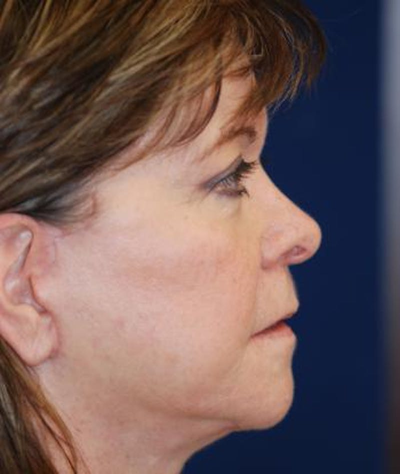 Facelift Before & After Gallery - Patient 333690 - Image 6