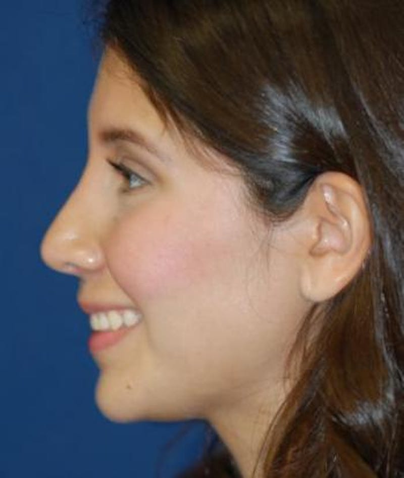 Rhinoplasty Before & After Gallery - Patient 357208 - Image 2