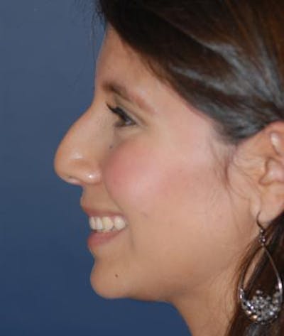 Rhinoplasty Before & After Gallery - Patient 357208 - Image 1