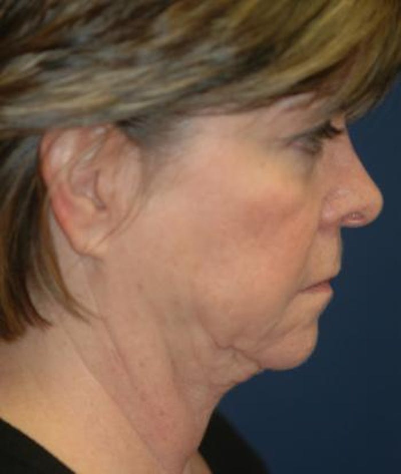 Facelift Before & After Gallery - Patient 333690 - Image 5