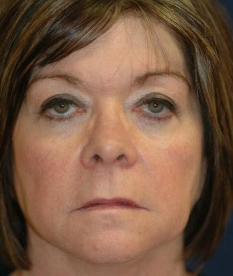Facelift Before & After Gallery - Patient 333690 - Image 3